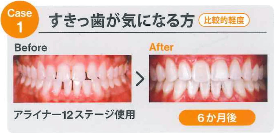case1 すきっ歯が気になる方