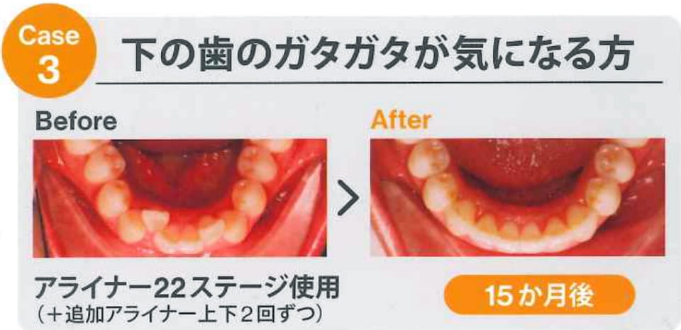 case3 下の歯のガタガタが気になる方