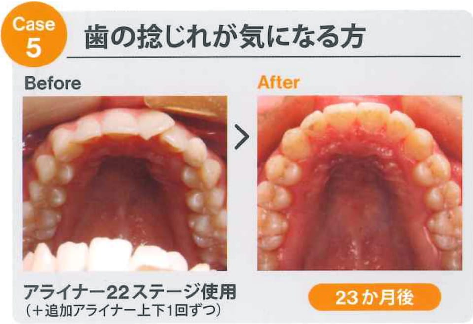 case5 歯の捻じれが気になる方