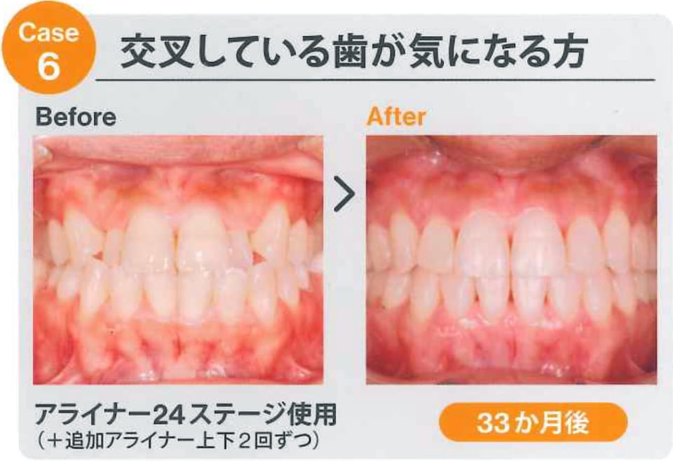 case6 交叉している歯が気になる方