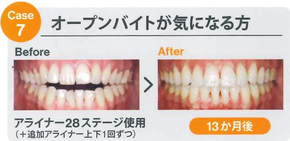 case7 オープンバイトが気になる方