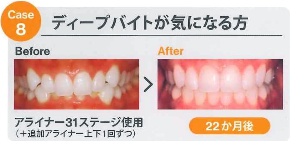 case8 ディープバイトが気になる方