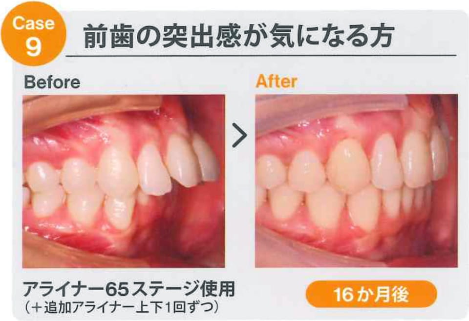 case9 前歯の突出感が気になる方