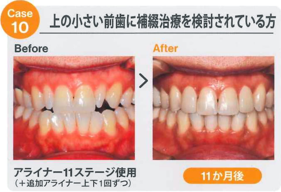 case10 上の小さい前歯に補綴治療を検討されている方